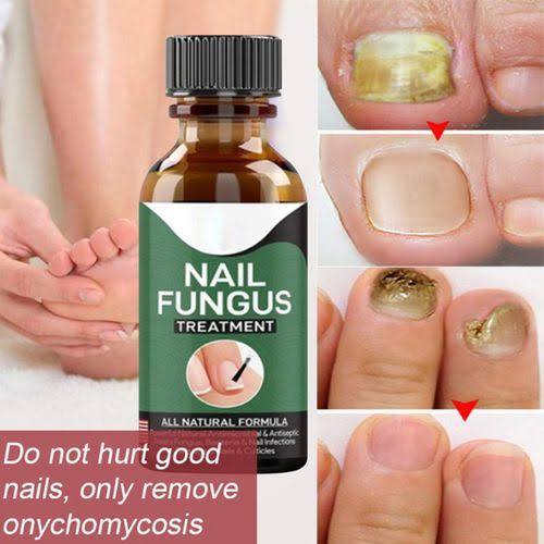 Foot Cure Nail Fungus Treatment – Natural Antifungal Oil for Damaged Nails