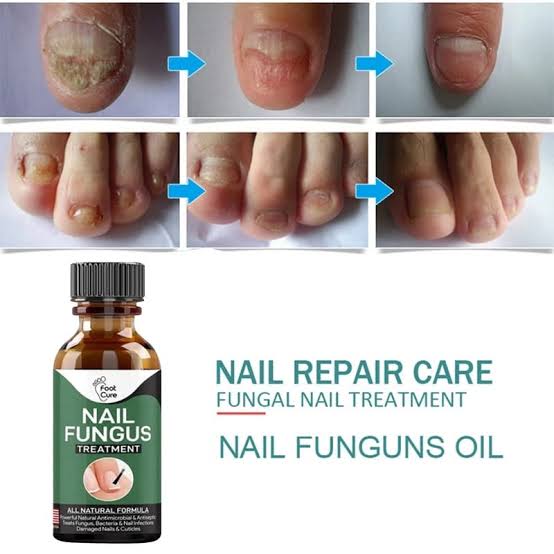 Foot Cure Nail Fungus Treatment – Natural Antifungal Oil for Damaged Nails