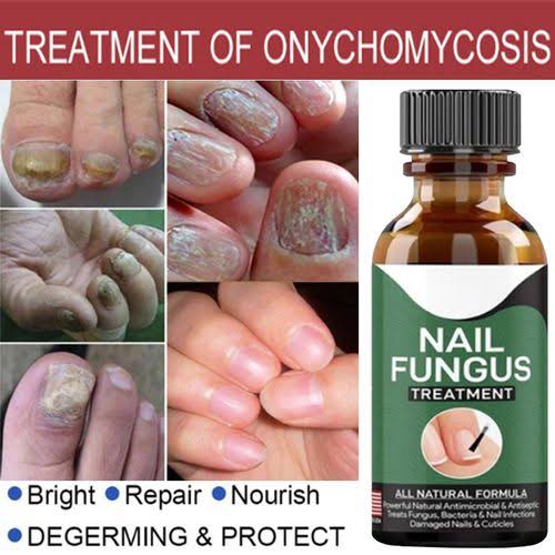 Foot Cure Nail Fungus Treatment – Natural Antifungal Oil for Damaged Nails